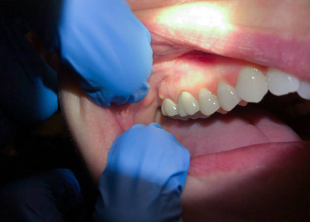 Best Emergency Wisdom Tooth Extraction in Lagunitas Forest Knolls, CA